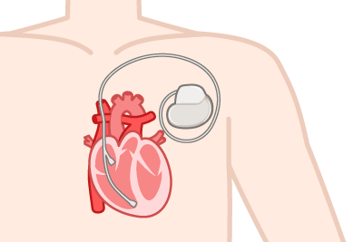 ペースメーカー外来