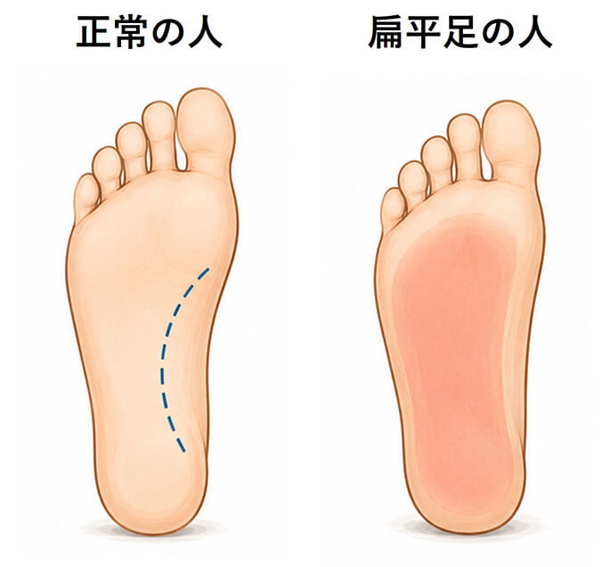 扁平足