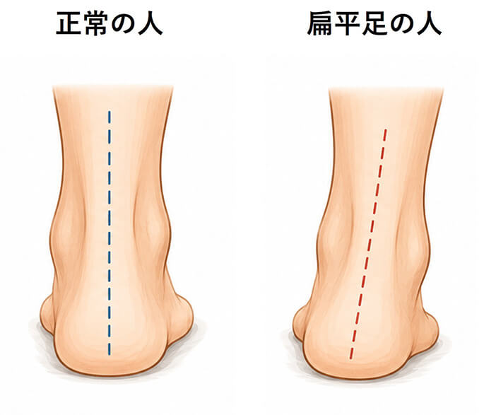 扁平足