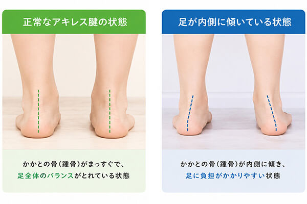 外反足